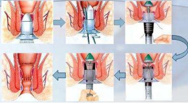 肛肠科的奇闻轶事,肛肠外科趣事