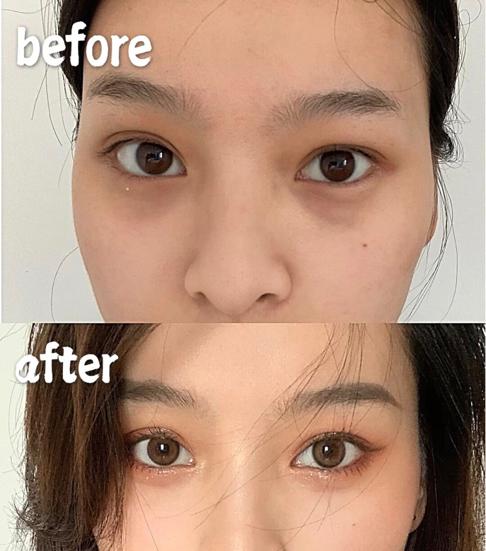 脸部什么纹路最显老,脸上显老的两条线