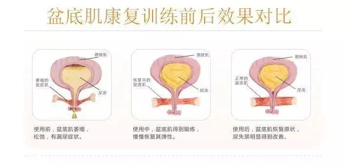 3.8女神节盆底肌修复宣传,三八盆底康复的优惠活动