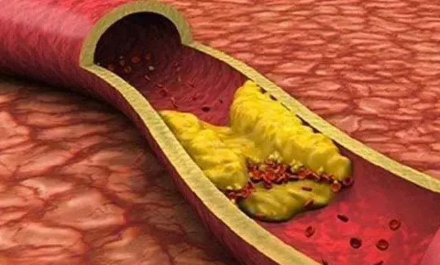 维生素k对骨质疏松的作用与功效,抗骨质疏松维生素k2