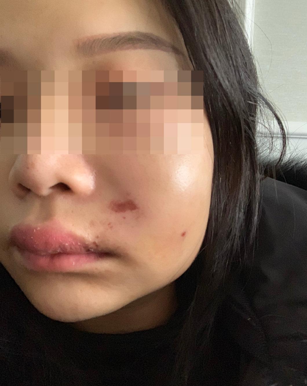 女子整容做酒窝失败,人造酒窝手术的样子