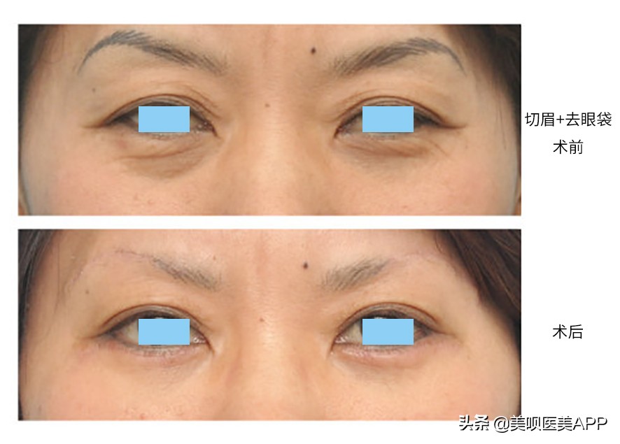 祛眼袋手术后多久恢复自然,西安哪家医院祛眼袋手术做的最好