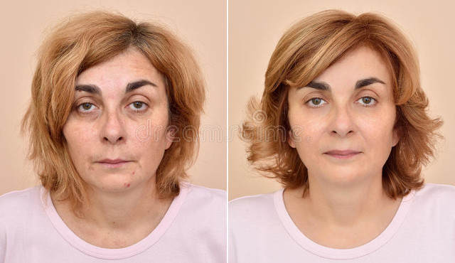 50岁头发稀少增发方法,16岁头发稀少如何增发