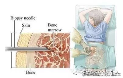 运城市第一医院肿瘤微创及综合介入科，特色技术—肿瘤穿刺活检术