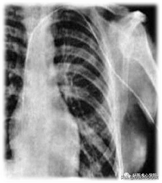 安贞医院冠心病介入治疗新技术,冠心病介入术