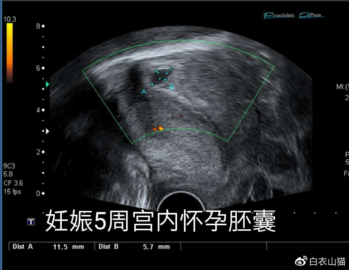 双胞胎一个宫内一个宫外大出血,双胞胎一个流产一个宫外孕