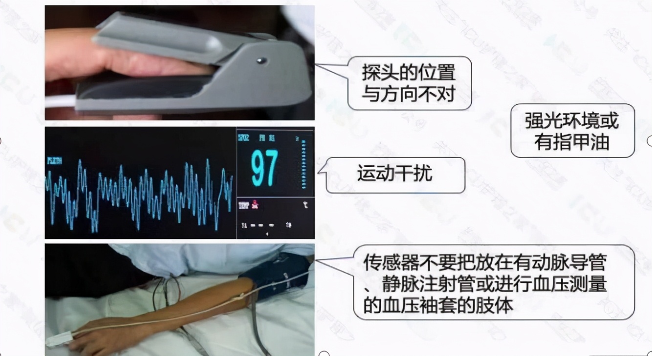 心电监护使用的收费标准,心电监护使用年限