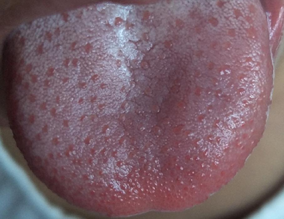 类风湿性关节炎是受凉引起的吗,类风湿关节炎可诱发什么病