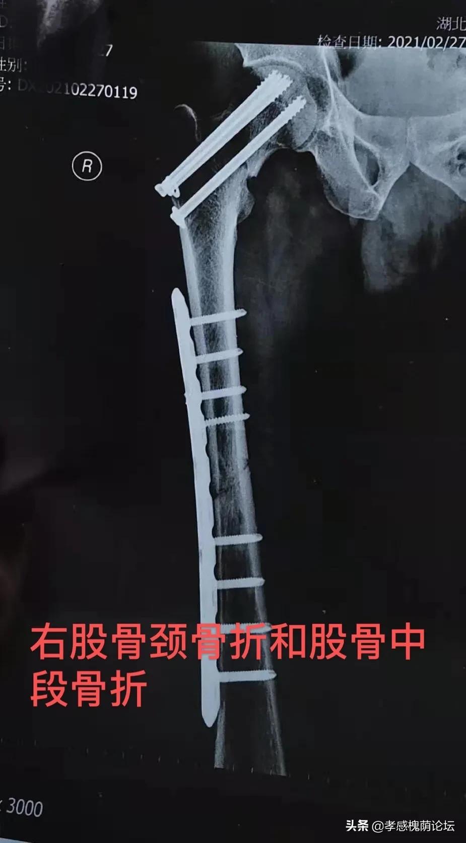 伤筋动骨一百天是对的吗,伤筋动骨一百天真的不能动吗