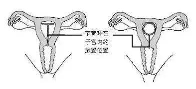 【健康】2600万被遗忘的中国女性,身体里还留着一颗“定时*弹炸**”!