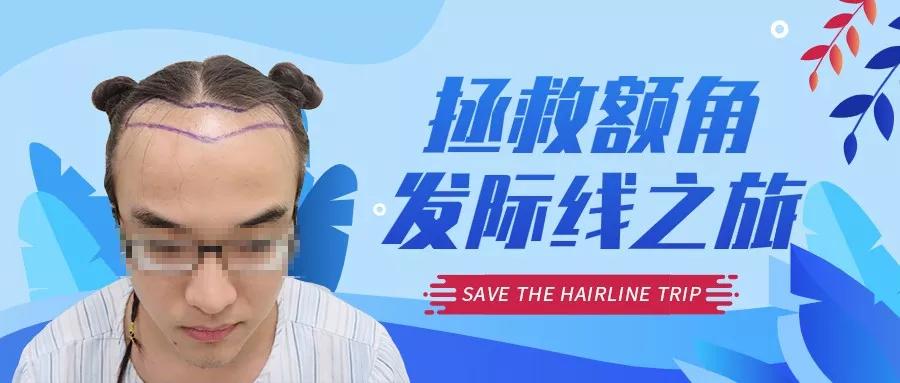 发际线后移额角大头发稀疏怎么办,额角发际线还能恢复吗