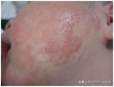 为什么肛周湿疹反反复复,嘴角湿疹反反复复怎么办