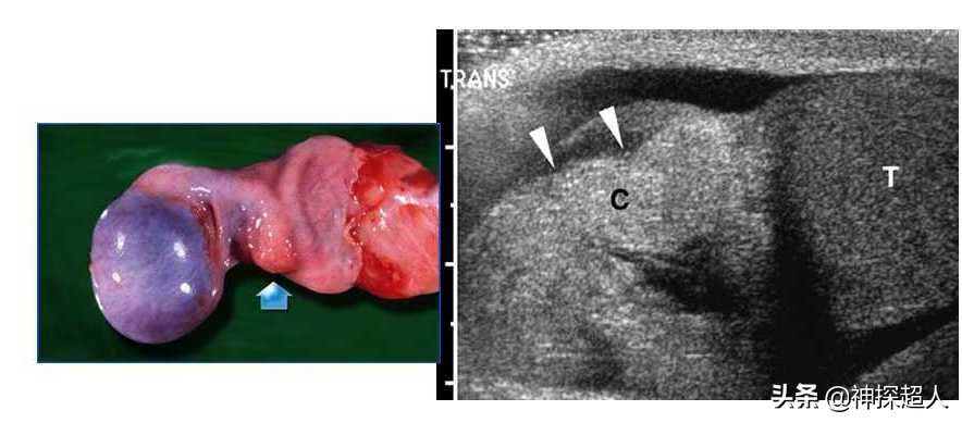 男性“蛋蛋”痛,必须引起重视,特别是一侧突发痛