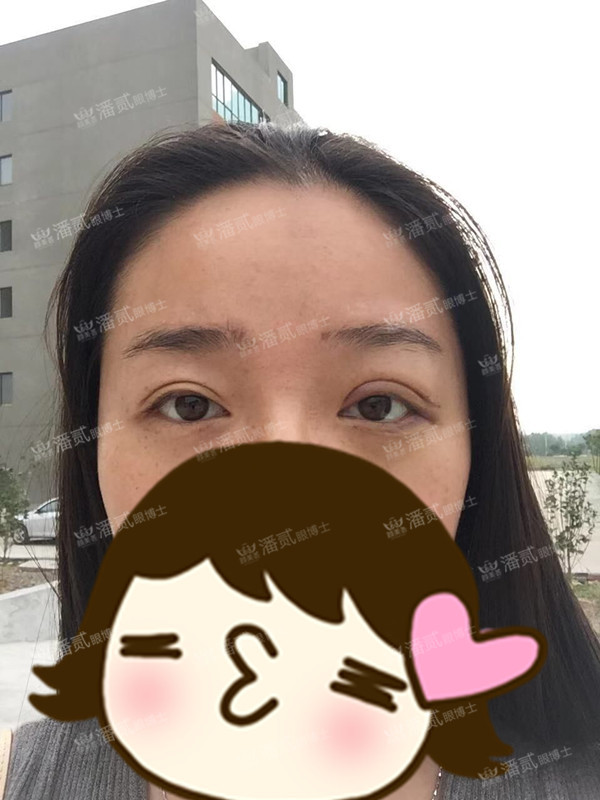 提肌矫正失败的表现眼皮睁不开,做完提肌眼睛前半段下垂