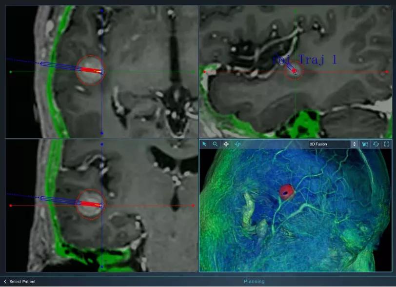 脑瘤不开颅手术成功案例,激光消融脑瘤手术