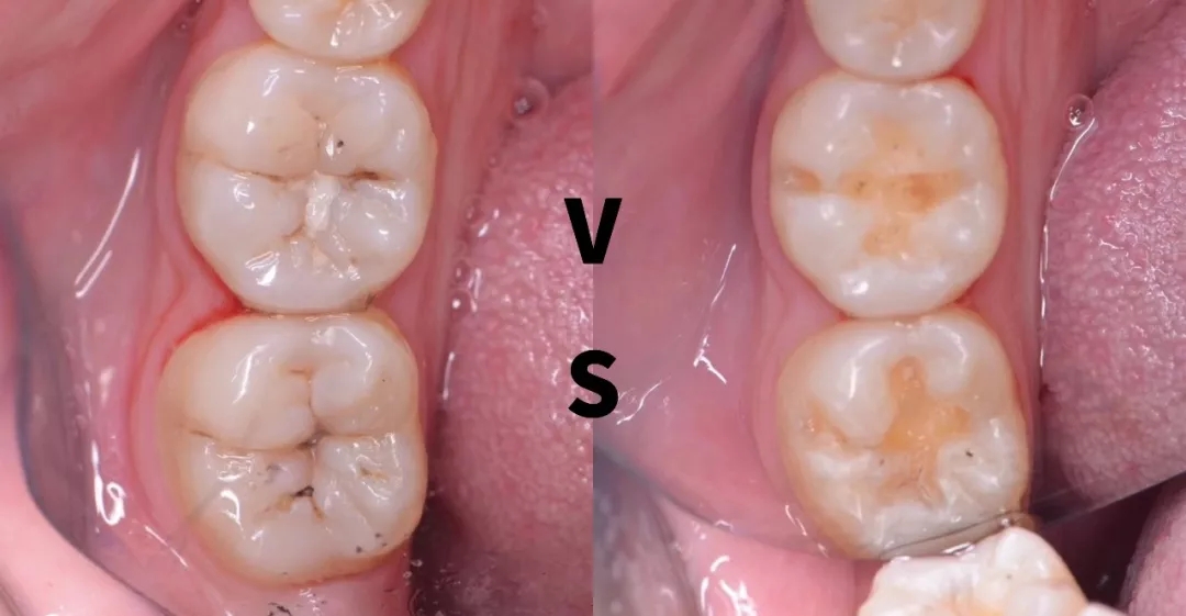 补个牙洞后为什么会出脓,补个牙医生把虎牙磨平了