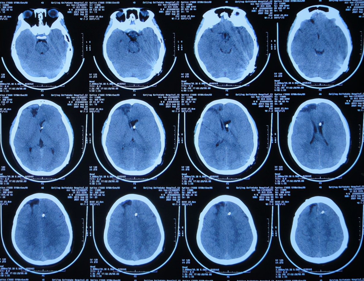 儿童脑出血昏迷三天后恢复正常了,脑出血后脑积水多久会出现症状