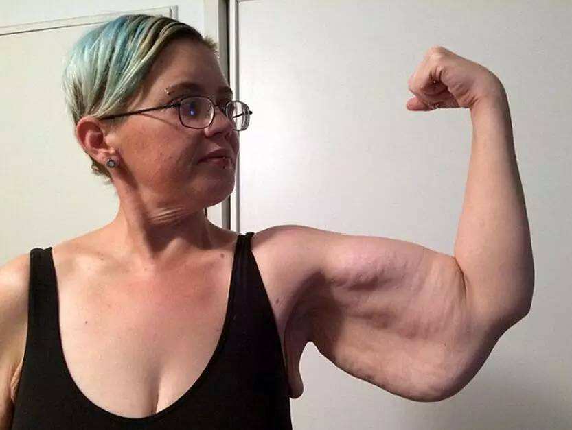 减肥皮肤下垂松弛怎么办,减肥后皮肤下垂