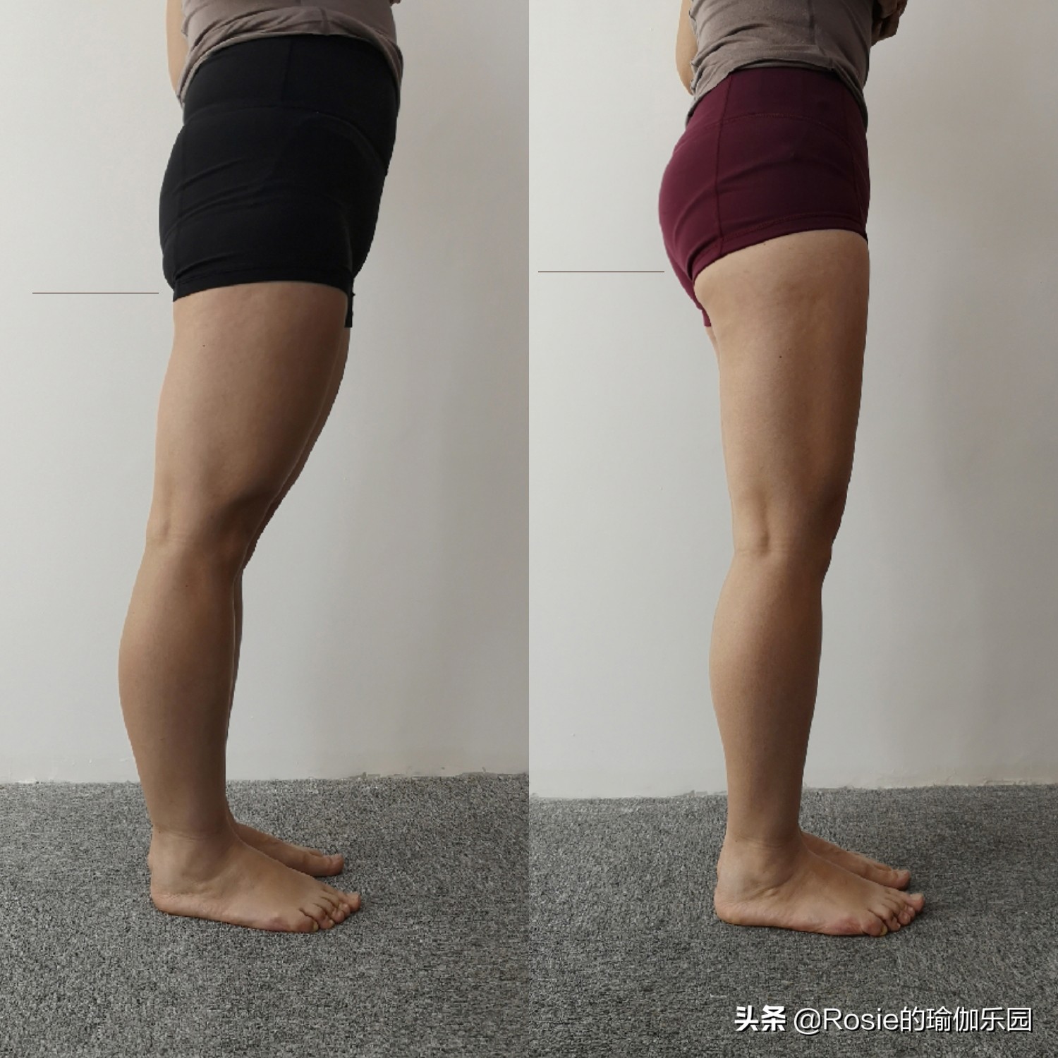 在腿上打瘦腿针20多针,瘦腿针多久能打第二针