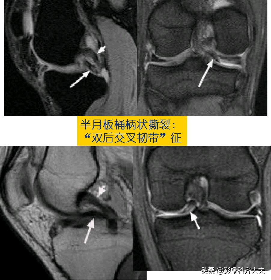 膝关节半月板损伤的磁共振,膝关节半月板病变的mri诊断与鉴别