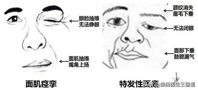 面肌痉挛打肉毒素能根治吗,面肌痉挛打肉毒素可以治愈吗