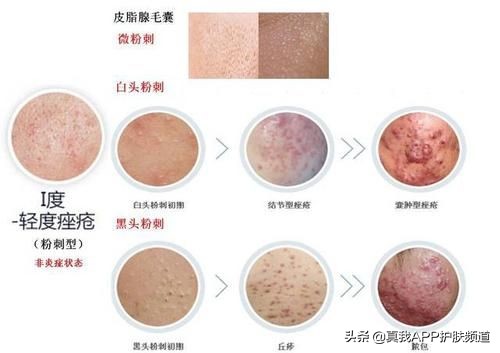 芦荟胶祛痘真的有效吗,芦荟胶和祛痘膏哪个祛痘效果好