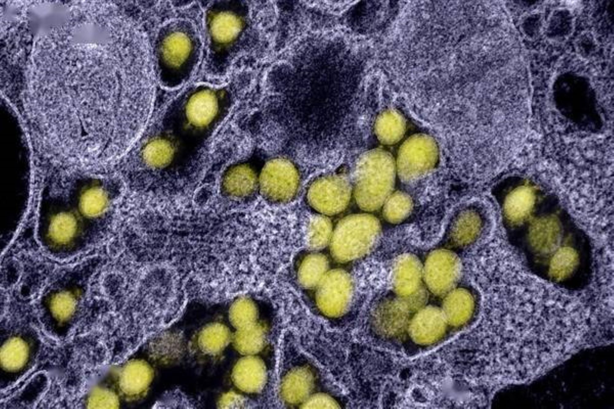 日本新型病毒是真的吗,蜱虫传染的新型病毒