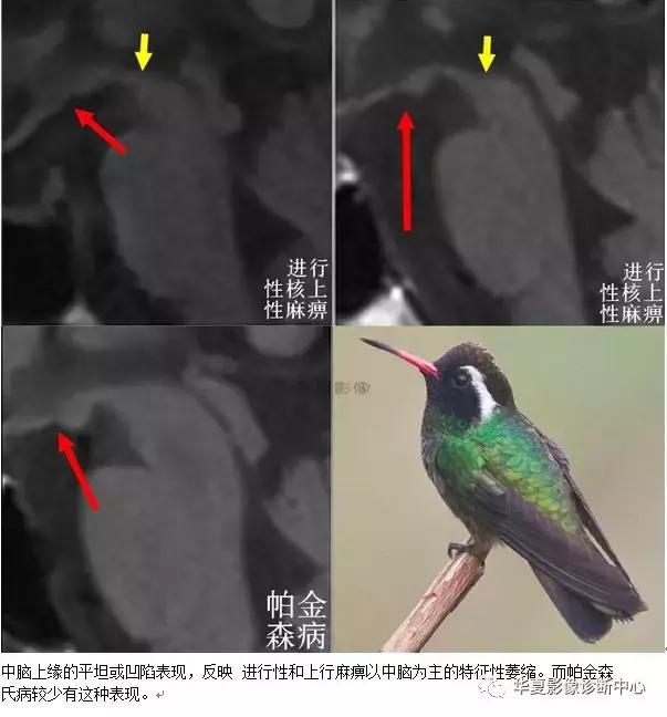 颅脑核磁影像解剖图谱,颅脑mr增强影像图片