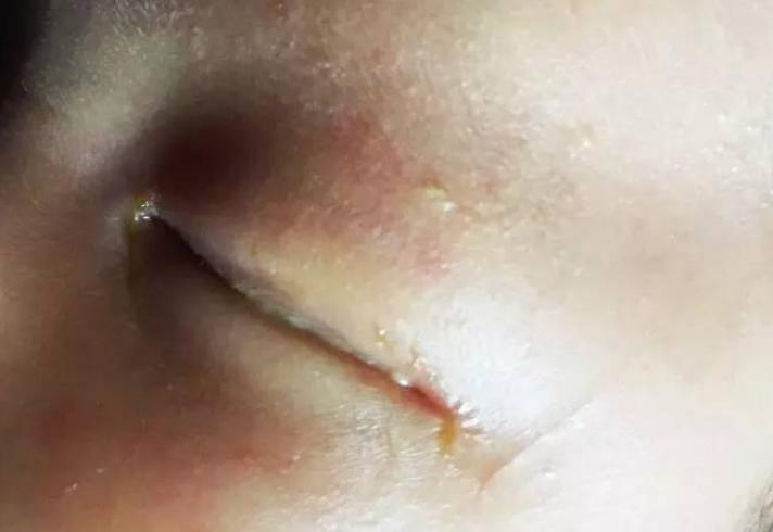 宝宝上火有暗示这6个部位要盯紧,宝宝夏季上火怎么办