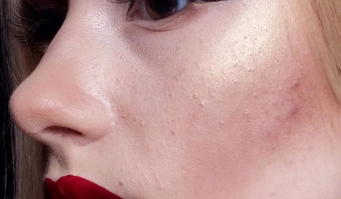 十大爆痘神器排行榜,战痘神器效果怎么样