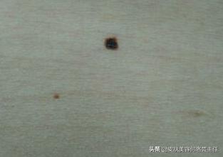 为什么色素痣会越来越多,有无色素痣都要注意什么