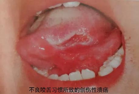 7岁宝宝嘴唇溃疡一大片，原因竟然是这个！#雅悦齿科#
