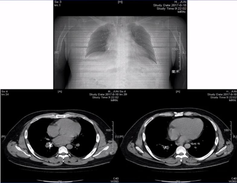 仓静教授最新视频,急性气道阻塞麻醉