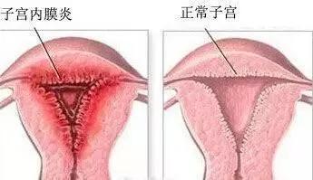 怎样的子宫内膜适合怀孕?吃柚子能长内膜?