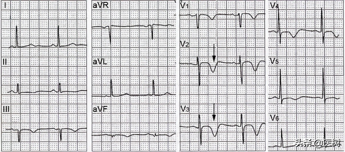 心电图t波改变是冠心病吗,心电图报告t波改变是冠心病吗