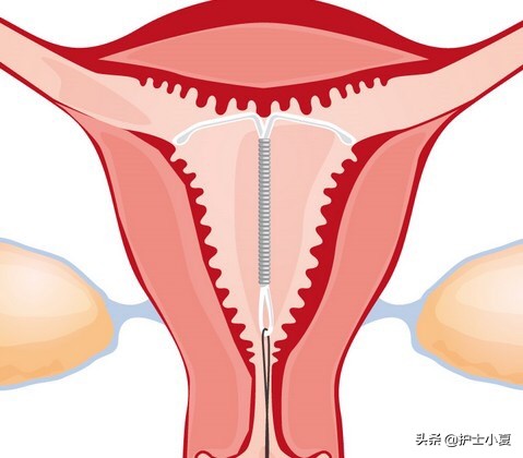 节育环可以终身不取出来吗,节育环能不能永久不取
