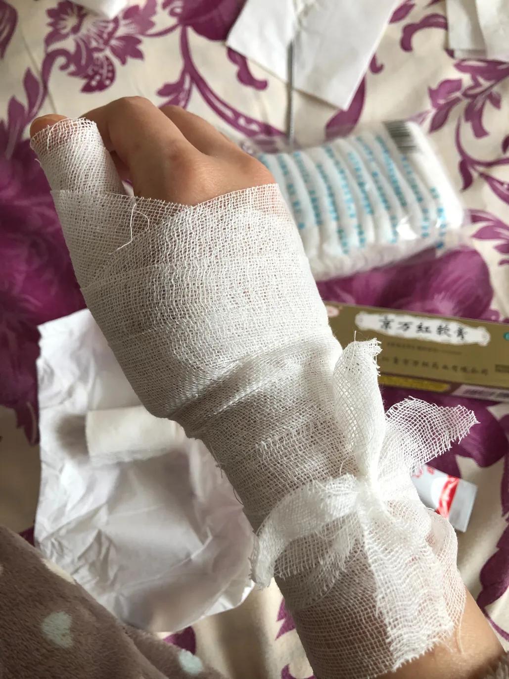 疫情期间低温烫伤的水泡怎么处理,烫伤后二十二天基本都平了