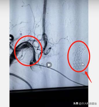 脑袋里有个血管瘤可以微创吗,脑血管瘤医生建议不用做手术