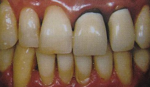 烤瓷牙牙龈发黑换了能恢复吗,烤瓷牙戴了十几年了牙根会坏掉吗