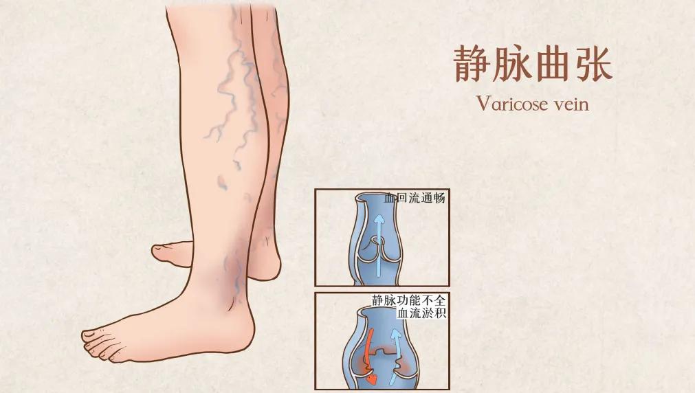 万万没想到，经常运动的我，孕期也没躲过静脉曲张