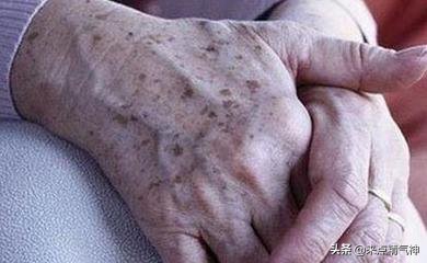 消除老年斑的十大良方,老年斑排毒手法