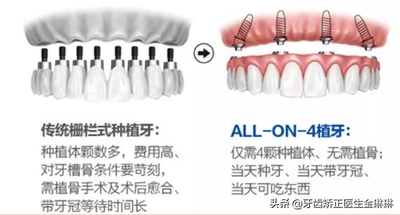 山东正规种植牙一颗大概多少钱,淄博种植牙价格多少钱啊