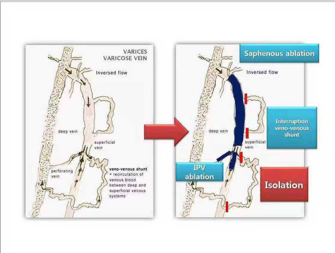 得了静脉曲张怎么办在家就能缓解 (得了静脉曲张这种病该怎么调养)