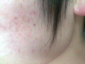 痘坑痘印|战“痘”达人的护理经验分享，内附修复攻略