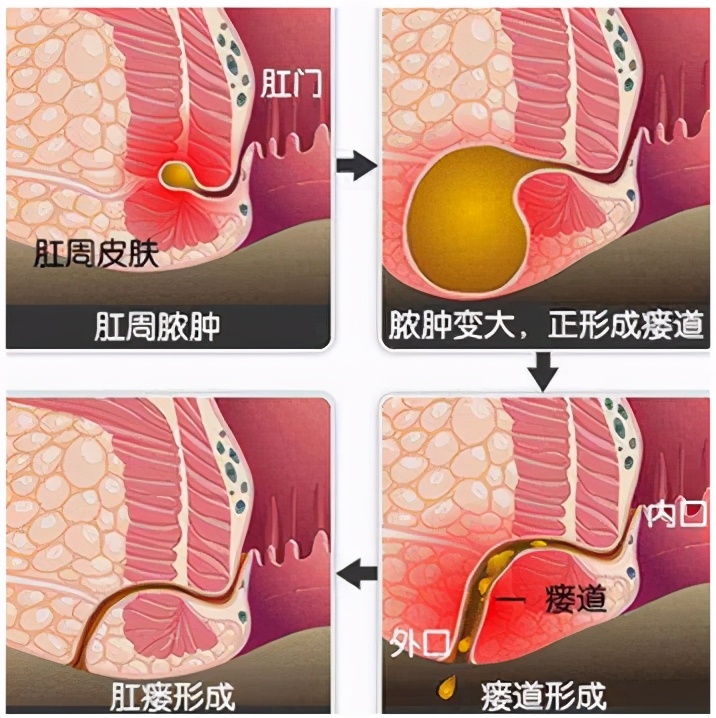 刚做了肛周脓肿怎样恢复得快,根除肛周脓肿的特效药