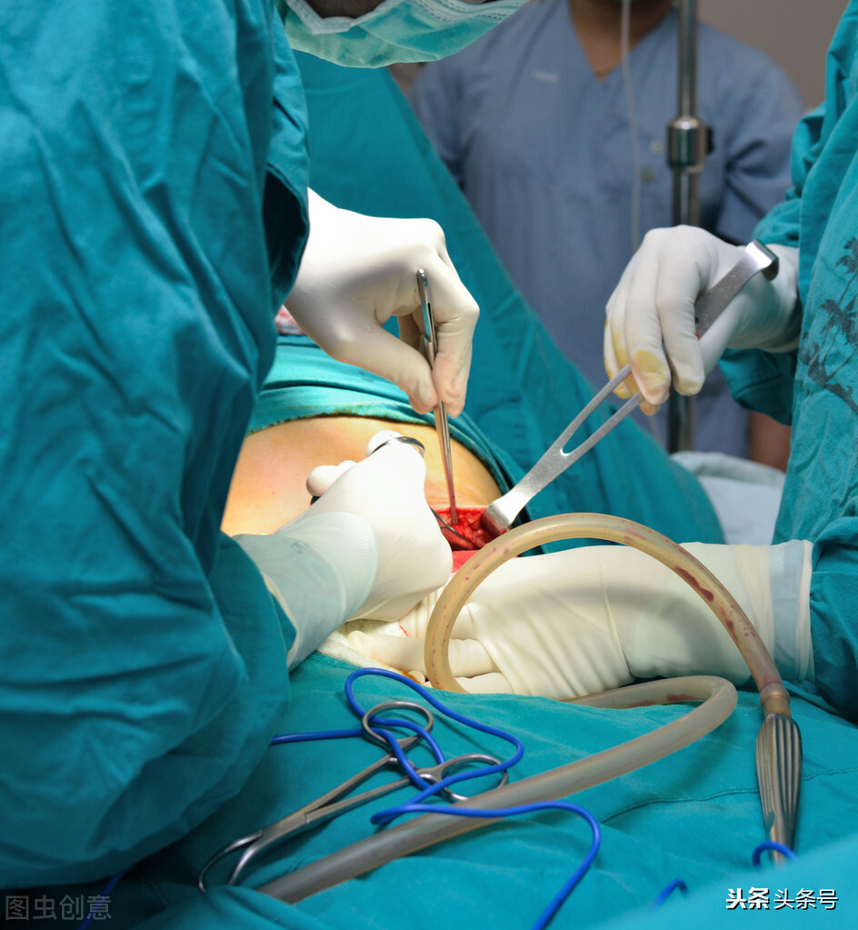 女子剖腹产后变成植物人,年轻女子剖腹产死亡后续