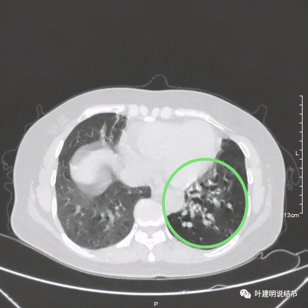 这样的实性结节伴小空洞会是肺癌吗?