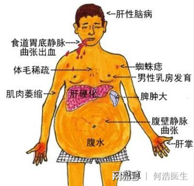 肝硬化皮肤瘙痒中医辨证,中医辨证治疗肝硬化腹水
