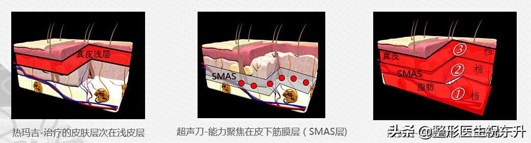 线雕热玛吉和超声刀哪种效果最好,热拉提热玛吉射频