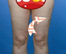 女子抽脂手术后续,女子抽脂突然没了呼吸心跳